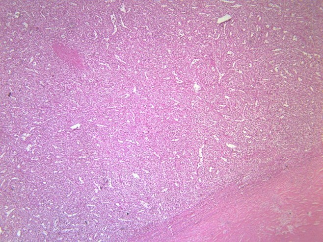 脾被膜玻璃样变显微切片图片