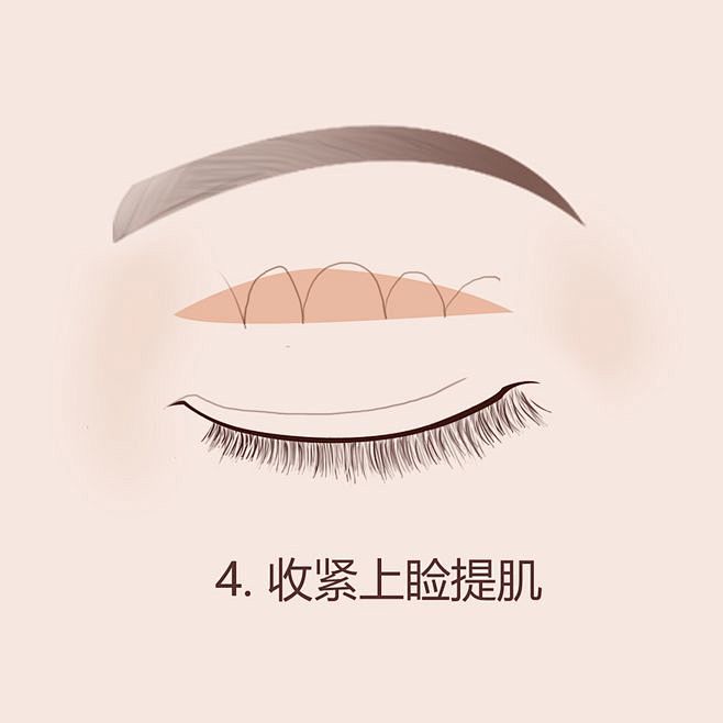 吊眼眼角下垂上睑提肌上眼睑下垂上眼睑下垂矫正上眼睑下垂矫正过程