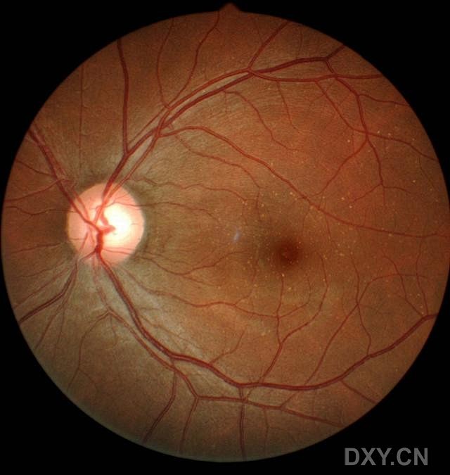白点状视网膜色素变性