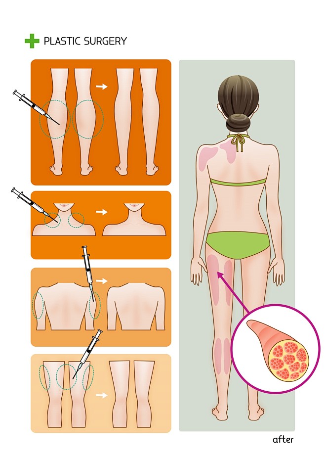 大腿环吸肩部背部大臂吸脂医美整形插画大腿肩部背部吸脂整形插画