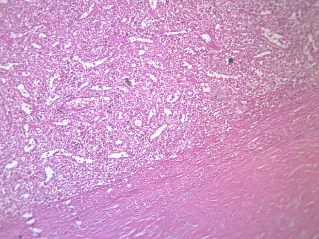 脾被膜玻璃样变显微切片图片
