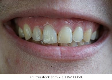 highsmilelinegummysmile