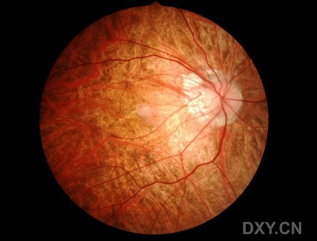 白化病眼底