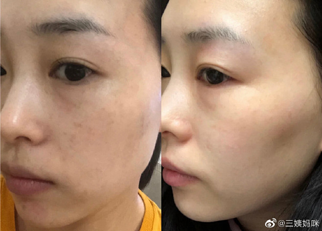 光子嫩肤3次后的对比也没那么那么神奇夸张光子嫩肤