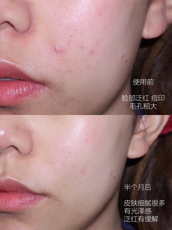 干皮敏感肌脸颊容易泛红生理期会长痘有一些痘印对于所有痘印图片女初