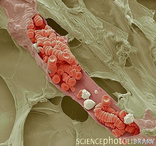 破裂小静脉中堆叠的红细胞