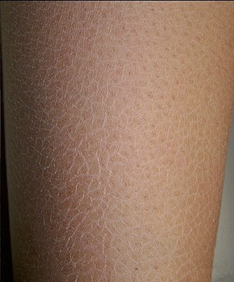 这种鱼鳞状"花纹"是皮肤干燥症(xerosis)的表现,常伴瘙痒,和皮肤功能