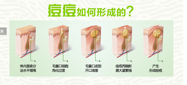 痘痘的形成过程是怎么样的？